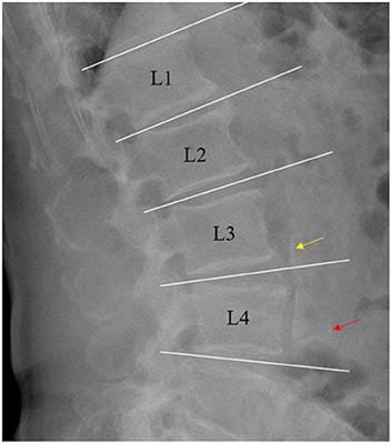 Prevalence and Correlates of Cardiovascular Calcification and Its Prognostic Effects Among Patients With Chronic Kidney Disease: Results From the C-STRIDE Study